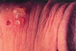 Blisters on Foreskin Picture