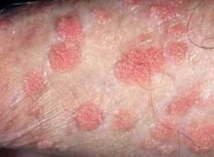 Eczema on Penis Picture