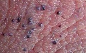 Pimple on Scrotum – Causes, Hard, White, Itchy, Large, Painful, Small