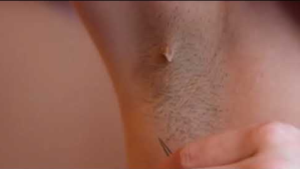 Ingrown Armpit Hair Picture