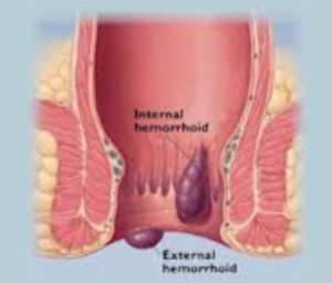 Lumps on Anus - Hemorrhoids