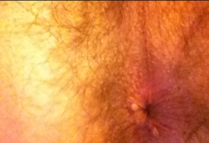 Small Lump on Anus