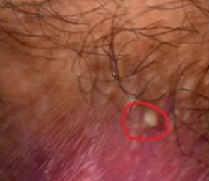 White Bump Near Anus Picture