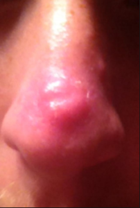 Huge Pimple on Nose