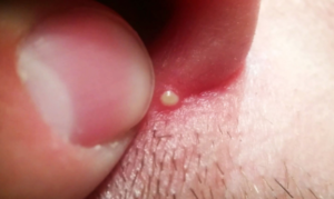 Pimple in Nose