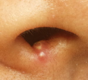 Pimple inside Nose Picture
