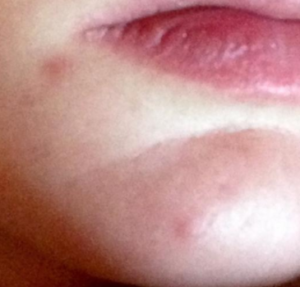 Blind Pimples on Chin