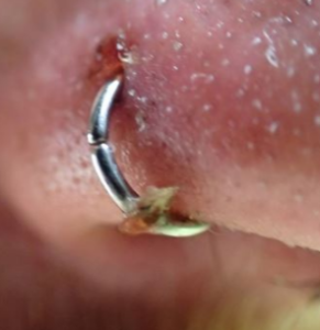 Infected Nose Piercing Causes
