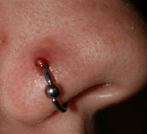 Infected Nose Piercing Picture