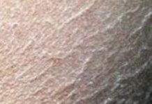 Dry Patches on Skin