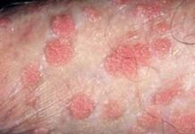 Eczema on Penis Picture