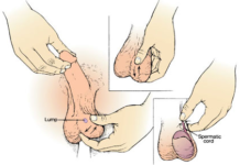 Lump on Testicles Picture