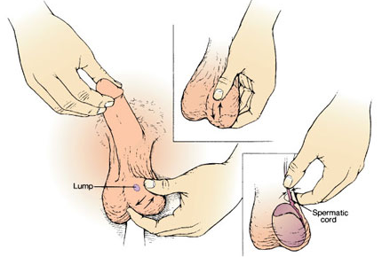 Lump on Testicles Picture
