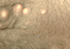 White Dots on Testicles Sac Picture