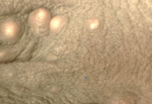 White Dots on Testicles Sac Picture