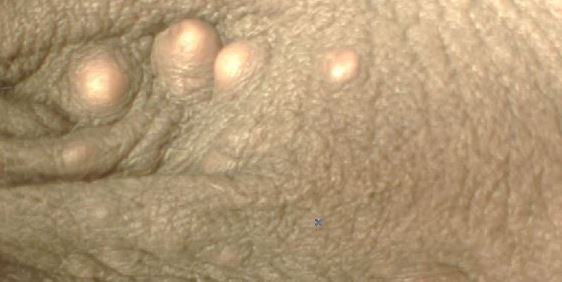Hard Pimple on Scrotum
