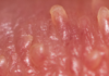 Pearly Penile Papules Removal