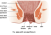 Sharp pain in anus could be Anal Fissures