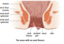 Sharp pain in anus could be Anal Fissures