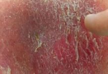 Dry Scab on Penile Skin