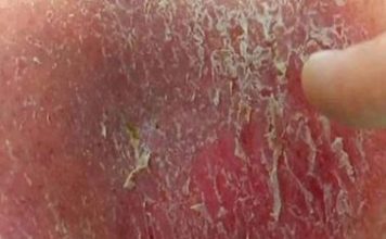 Dry Scab on Penile Skin