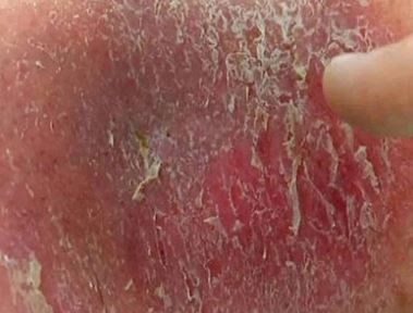 Dry Scab on Penile Skin