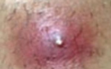 Infected Ingrown Hair