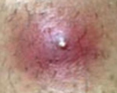 Infected Ingrown Hair: Symptoms, Causes, Pictures, Boils ...