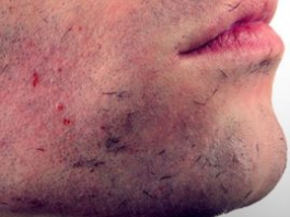 Ingrown Hair Archives Menshealthcure