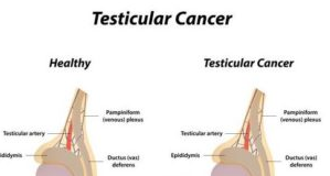 Pictures of Scrotal Swelling