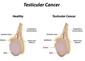 Pictures of Scrotal Swelling