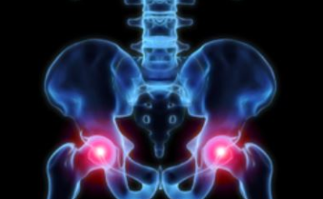Pinched Nerve in Hip