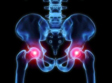 Pinched Nerve in Hip