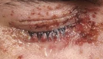 Shingles in Eye Symptoms