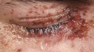 Shingles in Eye Symptoms