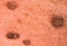 Skin tags on Penis Picture