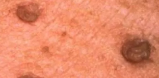Skin tags on Penis Picture
