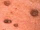 Skin tags on Penis Picture