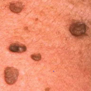 Skin tags on Penis Picture