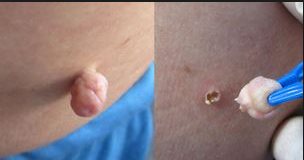 How to get rid of skin tags