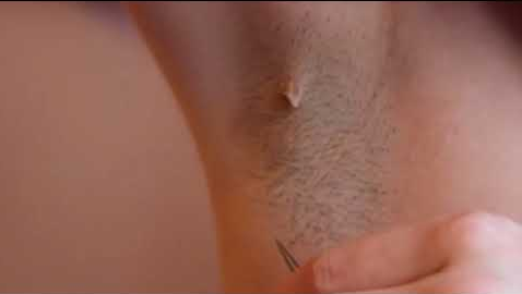 Ingrown Armpit Hair Cyst Lump Bump Lymph Node Symptoms Infected How To Get Rid Removal Home Remedies