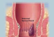 Lumps on Anus - Hemorrhoids