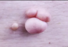 Pictures of Anal Skin tags