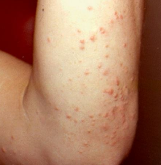 Red Bumps on Elbows