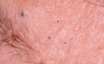 How to Get Rid of Blackheads