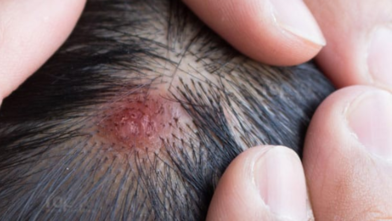 head-sores