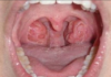 Holes in Tonsils