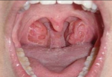 Holes in Tonsils