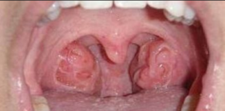 Holes in Tonsils