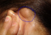 Lump behind Ear